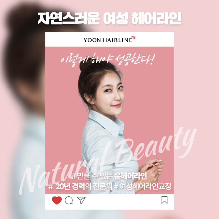 자연스러운 여성 헤어라인 모발이식, 이렇게 해야 성공한다!