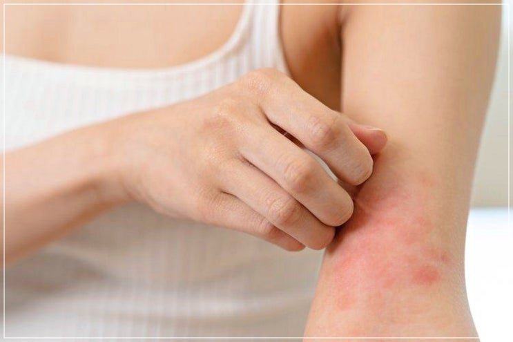 얼굴 입가 피부 마른버짐 원인 및 철저한 관리 방법 얼굴 입가 피부 마른버짐 원인 및 철저한 관리 방법