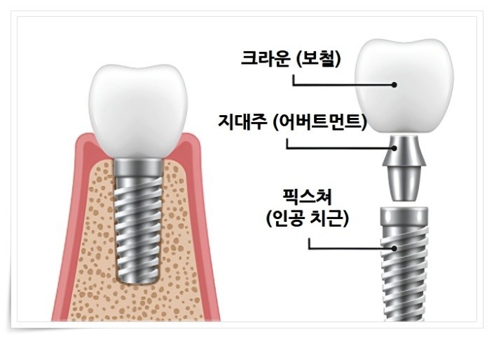  치과 치료 임플란트란 무엇인가 기성과 맞춤 커스텀의 차이