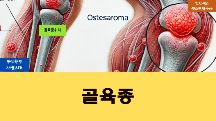 골육종 증상 원인 및 재발 치료