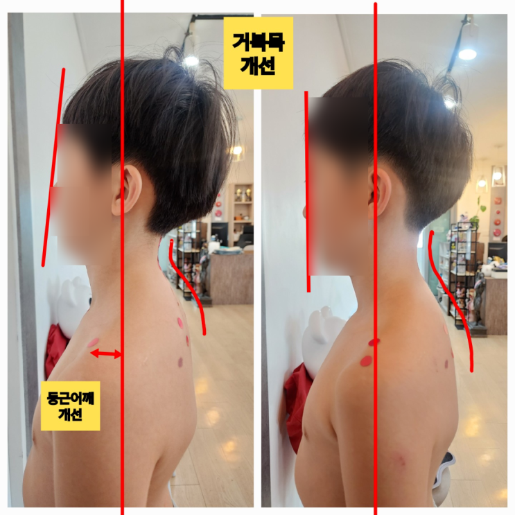  부산 화명동 어린이자세교정, 거북목과 굽은등 체형교정 한달 후 비포에프터