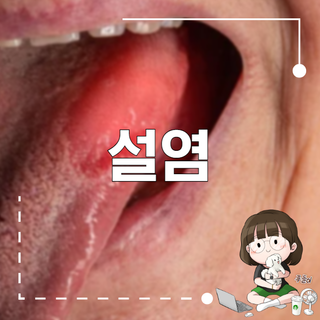 설염 치료 증상은 어떻게?