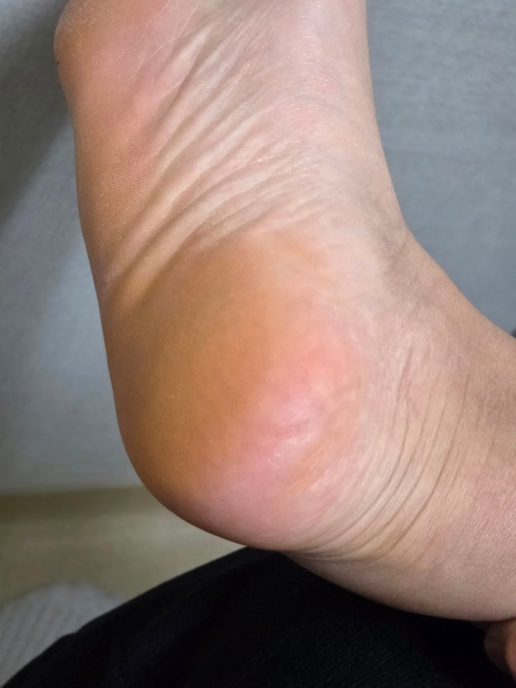  발뒤꿈치각질 제거기 순식간에 아기발 되는법