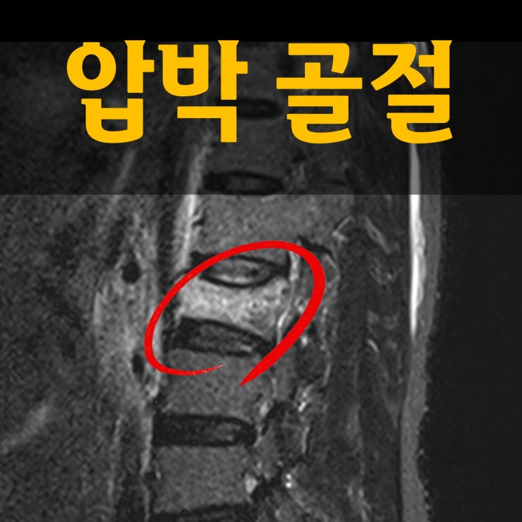  흉추 요추 척추 압박골절 환자의 치료 (식단관리)