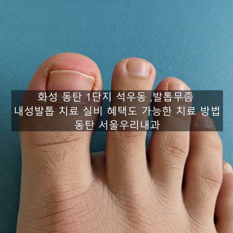 화성 동탄 1단지 석우동 ,발톱무좀 내성발톱 치료 실비 혜택도 가능한 치료 방법
