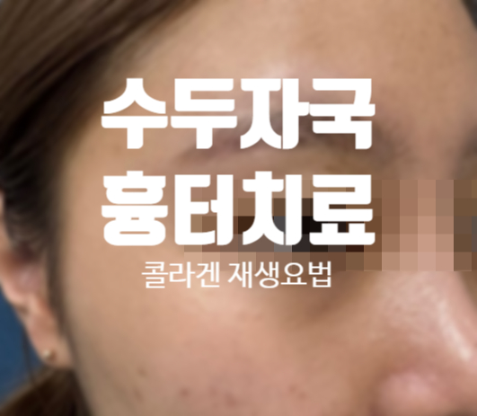  수두흉터 피부치료 레이저 연고 효과 (의사 직접작성, 의학적 설명)