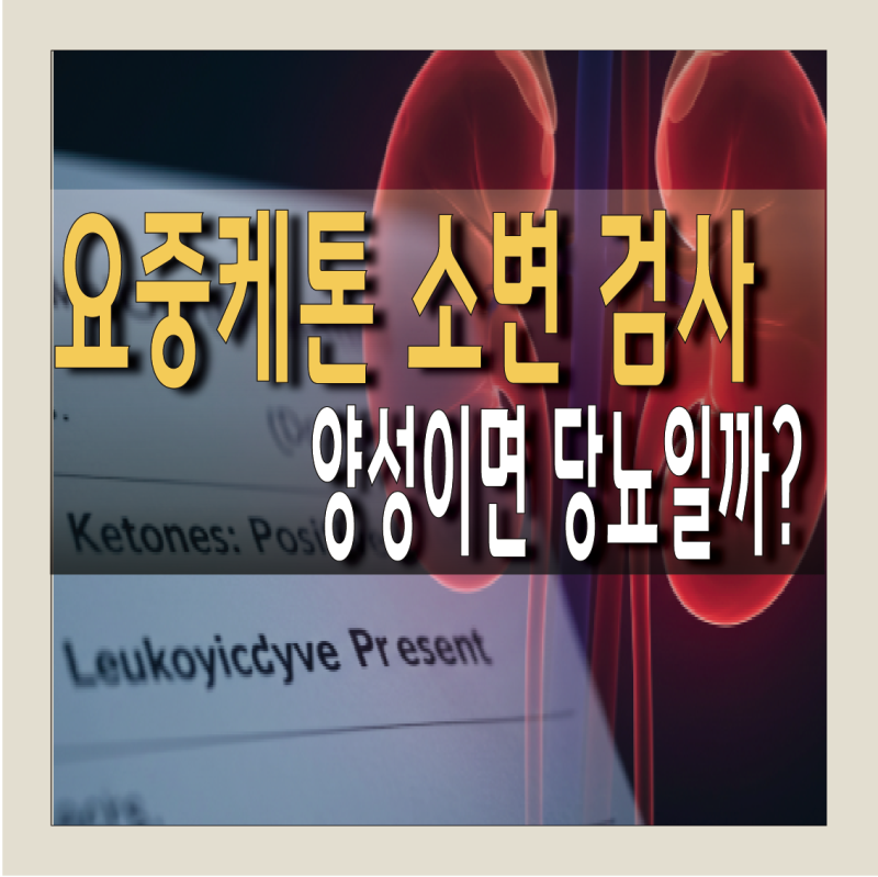 요중케톤 소변 백혈구 검출, 양성이면 당뇨일까?