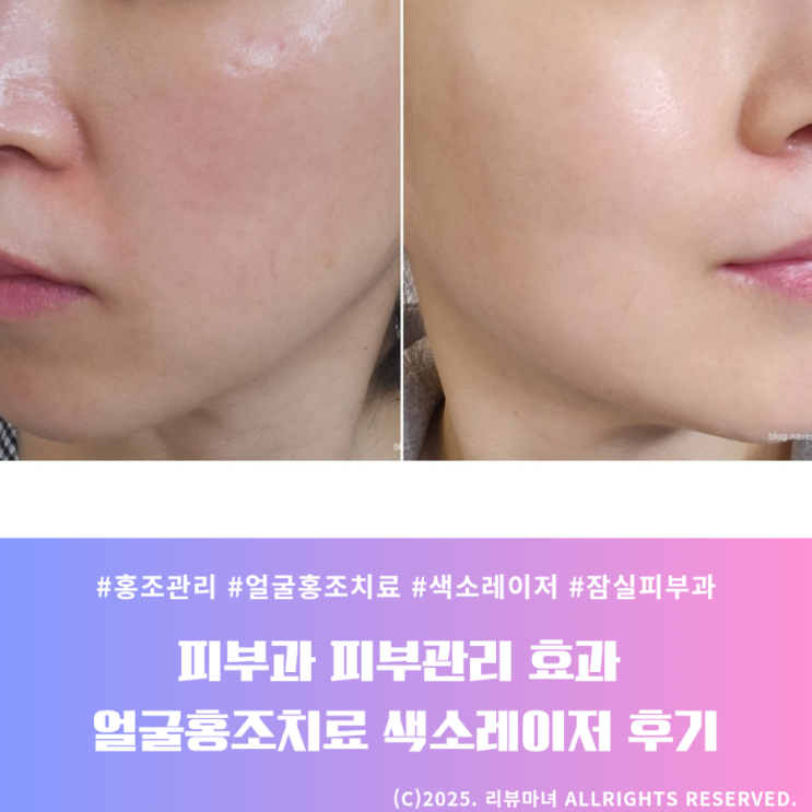  [ 피부과 피부관리 효과는? ] 얼굴홍조치료, 색소레이저 관리 후기