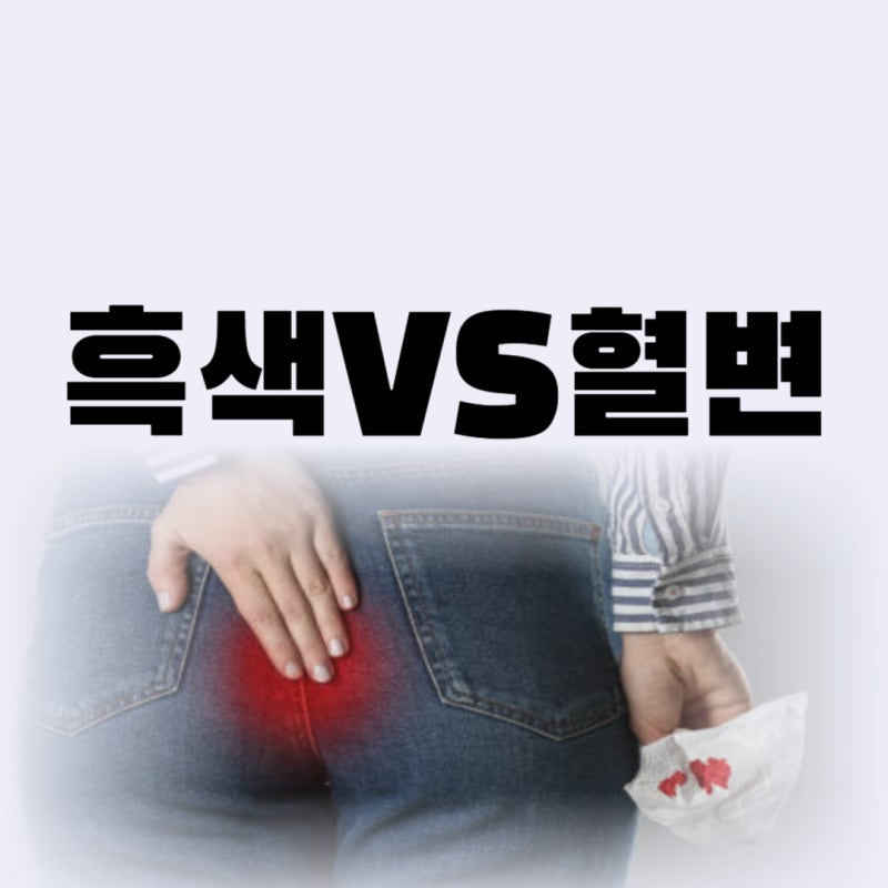 melena 흑색변 hematochezia 혈변 차이