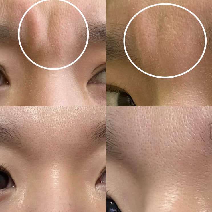  둔산동 보톡스 잘하는 곳에서 미간 수입 디스포트 보톡스 맞고 왔어요(+ 가격 내성 유지기간 등 정리)