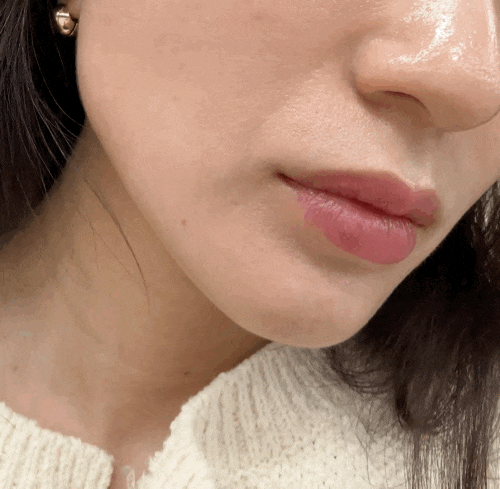  연신내피부과 보톡스 추천 이마미간 사각턱 전후비교