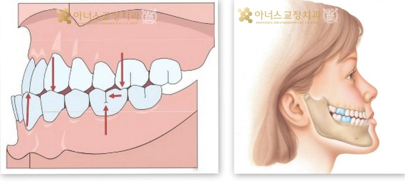 3급 부정교합의 정의와 진단, 조기 교정치료, 1차교정, 턱교정