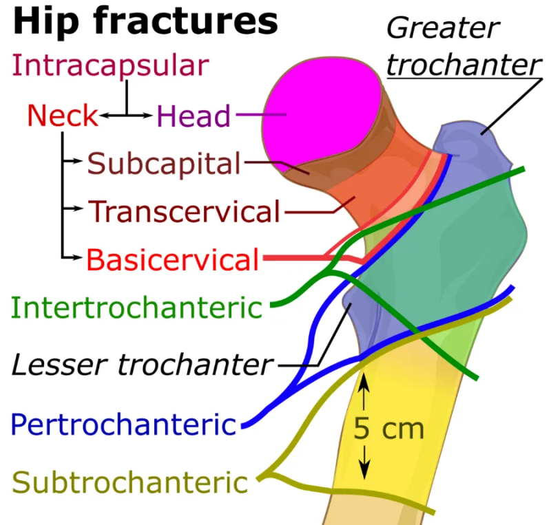 대퇴골 골절 Hip fracture 수술 - 경부, 전자간, 전자하 골절 차이 : 네이버 블로그