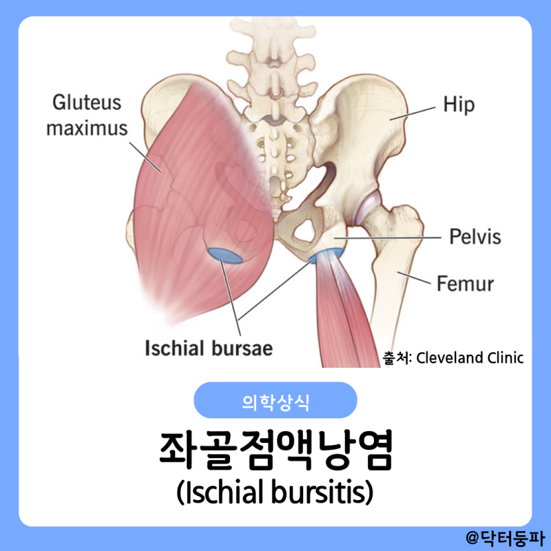 좌골점액낭염 증상 병원 치료