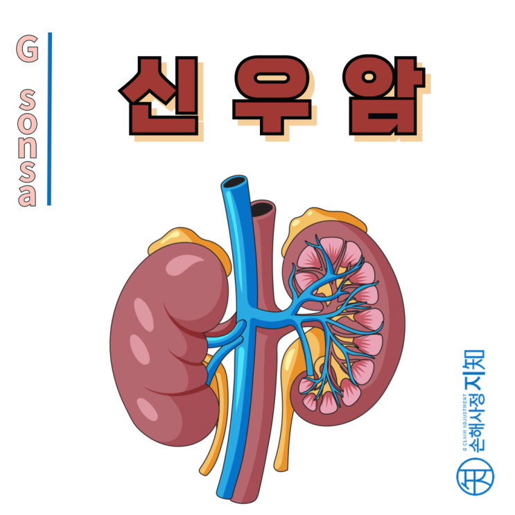  신우암 증상부터 보상까지, 당신이 모르는 조용한 암의 모든 것 - [암정보, AlDa]