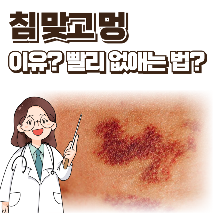  침맞고 멍 드는 이유, 빨리 없애는 법?