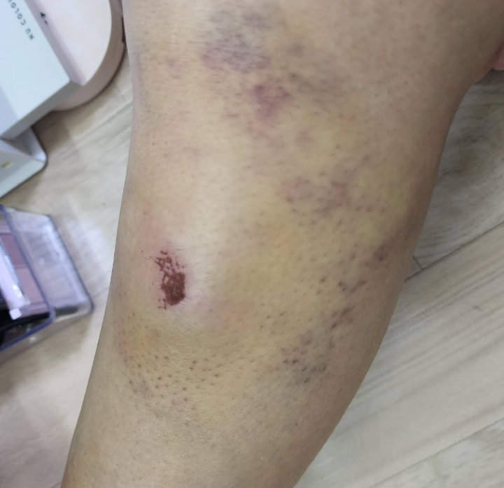 타박상에 물리치료가 효과적일까?