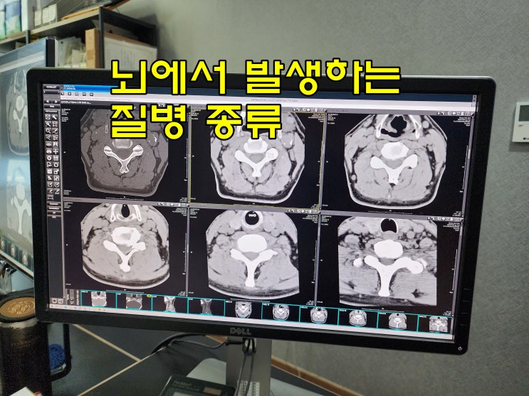  뇌 질병 종류 111가지