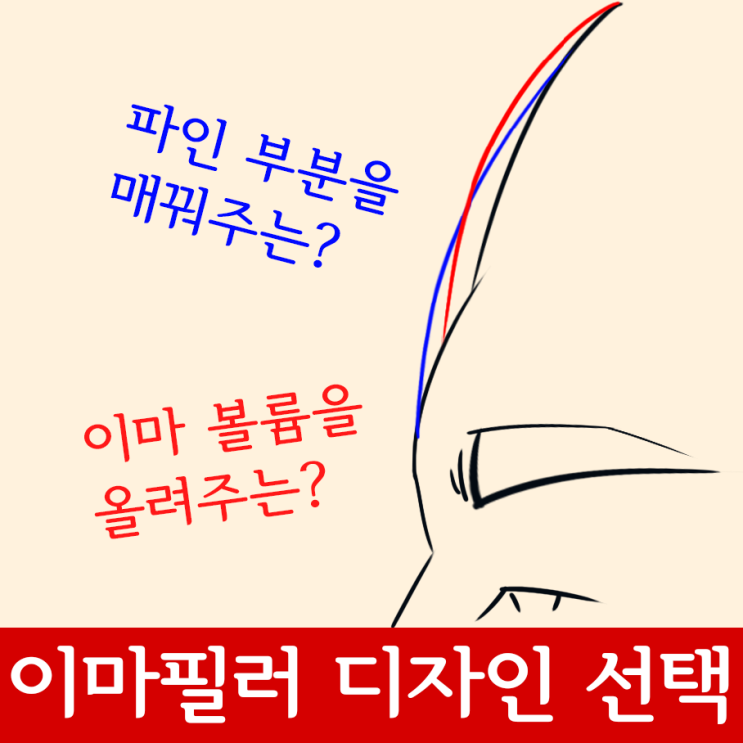  이마필러 디자인 선택하고 시술하기