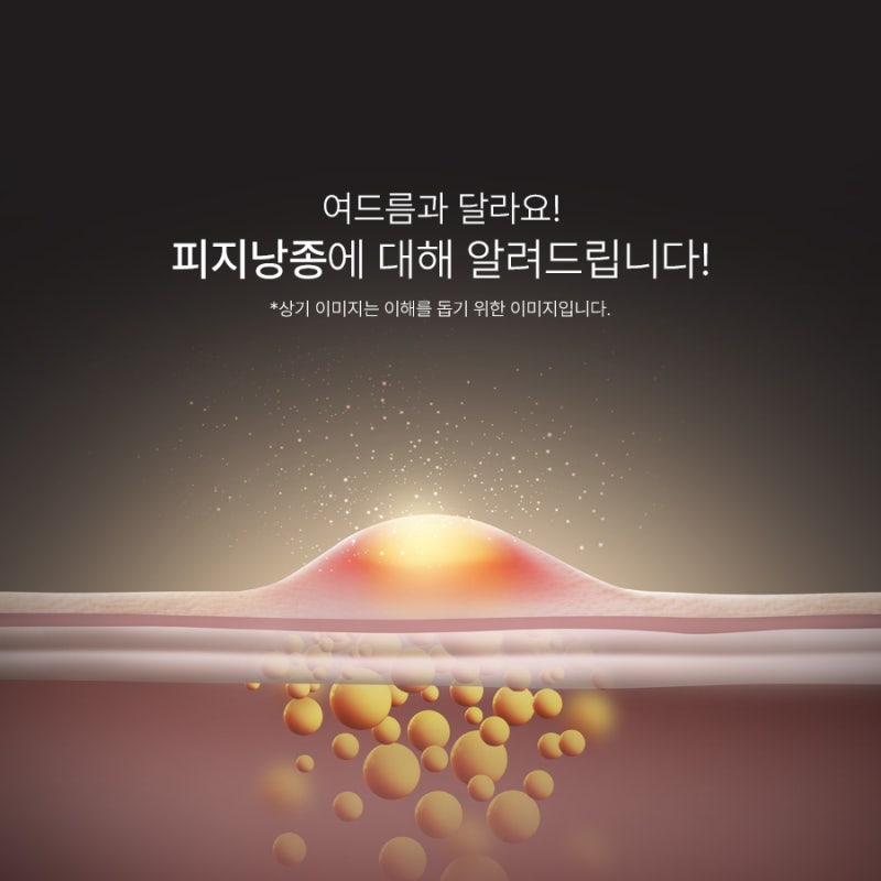포항피지낭종으로 고민이라면 치료 어떻게?