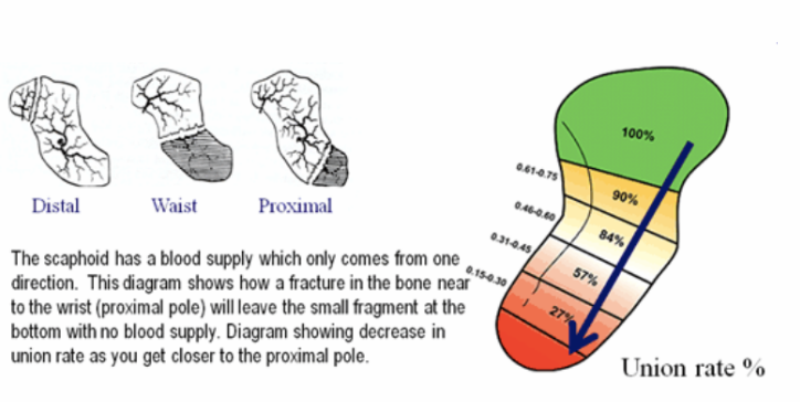 Osteosynthesis for nonunion, scaphoid + Iliac bone graft (feat. Billiard view)