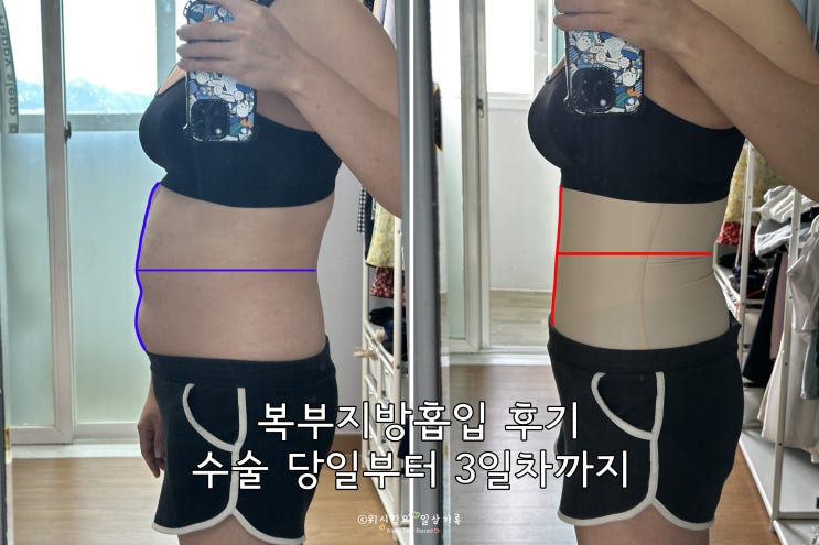  복부지방흡입 후기 당일부터 3일차까지(붓기, 통증, 멍, 부작용, 효과)