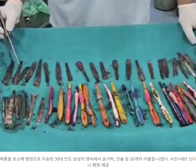  “배 아파 죽겠다”던 남성, 뱃속에 숟가락·칫솔 50개…왜 삼켰나? 