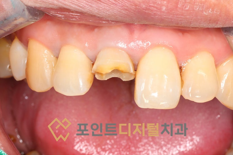  [탕정치과]  발치전 치아를 살리는 마지막 치료 캐스팅 포스트 치료 / 천안 아산 불당 배방