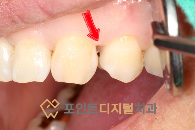  [탕정치과]  인레이 대신 레진으로 치료하기(터널링 테크닉) / 천안 아산