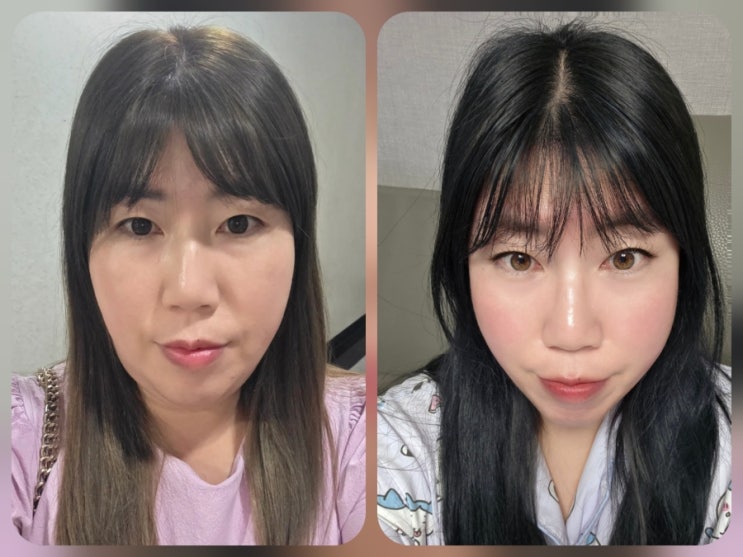  [연산동]이중턱을 뿌시고 라인을 만들어주는 부산브이로리프팅 한달 후기