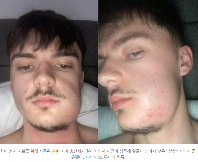  "얼굴이 왜 이래?"  치아 충전재가 부른 충격적 사건