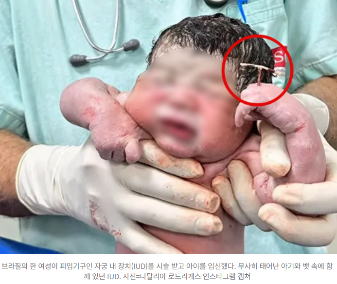  IUD 피임에도 태어난 기적의 아기…“승리의 트로피 쥐고 나왔다”