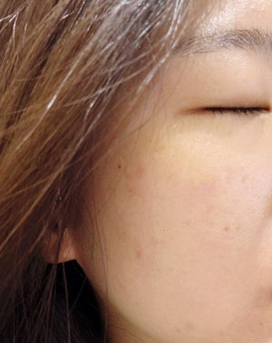  편평사마귀 레이저 제거 후기 개인, 공장형 비교 (비용, 시간, 통증)