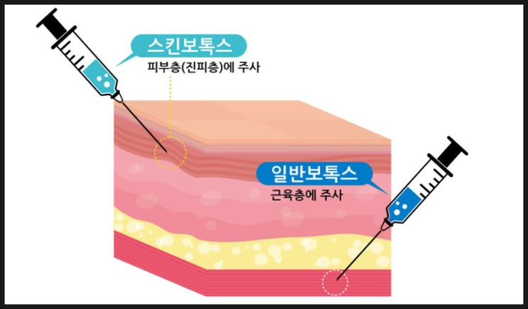 영등포스킨보톡스 효과 알아보고