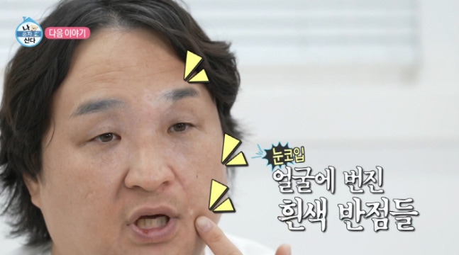 <b>구성환</b>, <b>백반증</b> 치료 중 극심한 <b>고통</b> 호소…‘나 혼자 산다’... 