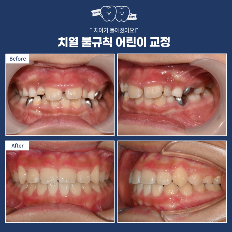  일찍 시작하는 어린이 교정, 무턱교정, 주걱턱 교정, 책임관리 시스템이 중요합니다.