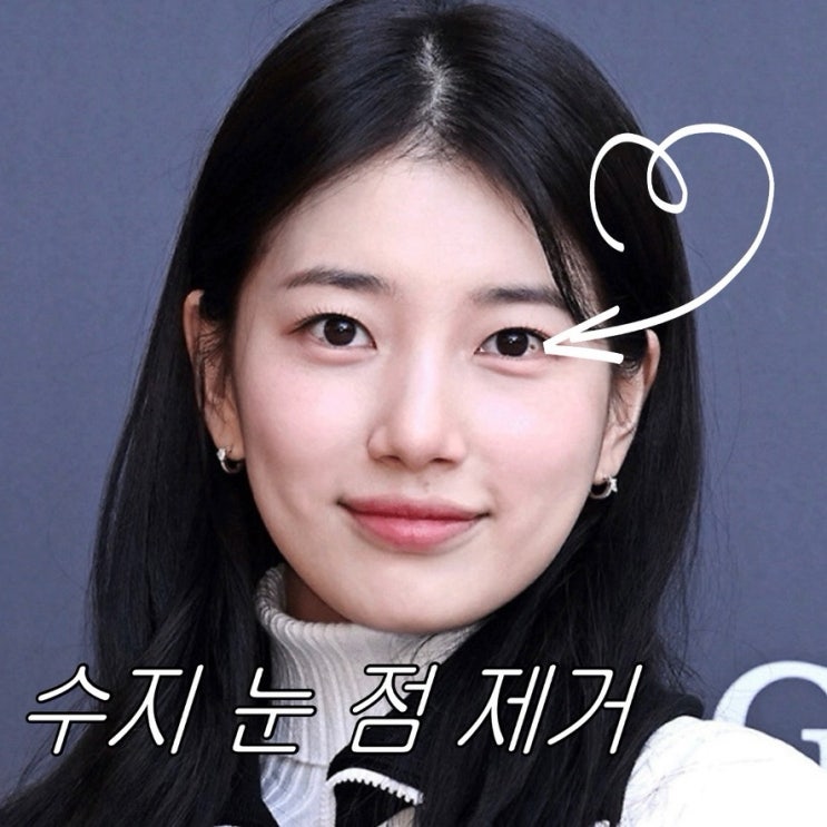 수지 눈동자 점 사라진 이유｜결막모반 제거와 실제 시술 정보 정리