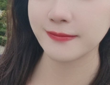 분당 서현 피부과 여드름 라라샷Q 리뷰