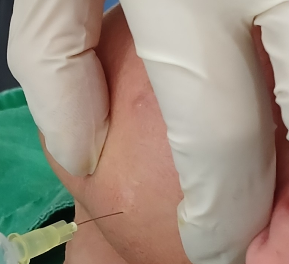 구강외과 전문의가 평택 안성 턱관절 주사치료 발통점 주사(TPI, 통증주사)에 대해 정리해드립니다.