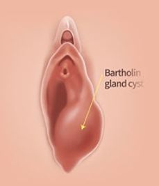 바톨린 낭종 원인 증상 치료 완벽 정리, 바르톨린선 낭종이란?