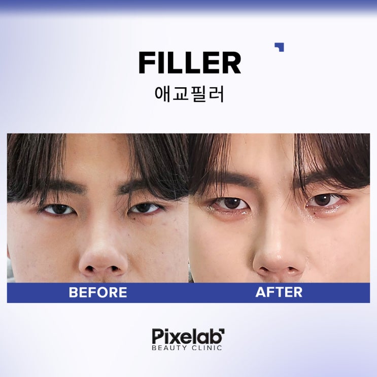  강남 애교필러 추천 전 필독! 후회하지 않는 2가지 기준