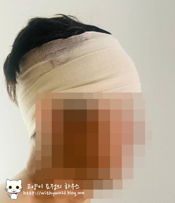  남편인생 첫 성형수술 후기 - 2. 내시경이마거상술+추미근 절제 후기(수술당일부터~2일차)