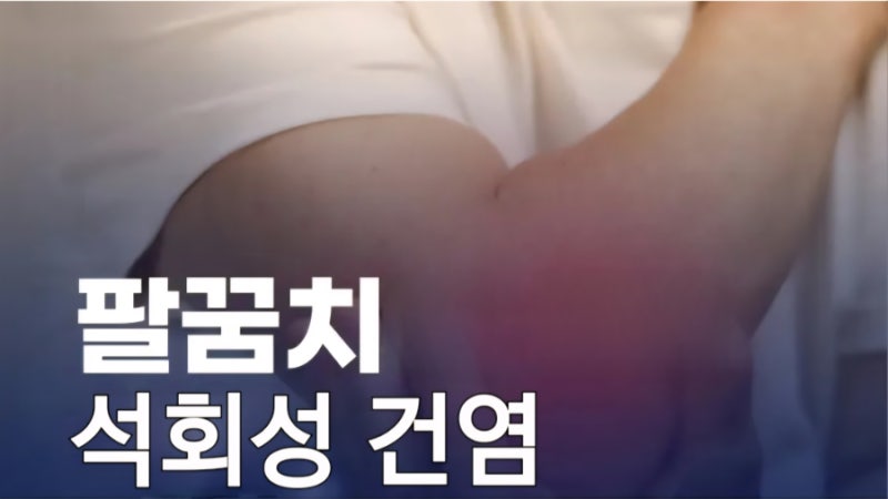 팔꿈치가 많이 아파요~⧫팔꿈치 석회성 건염⧫