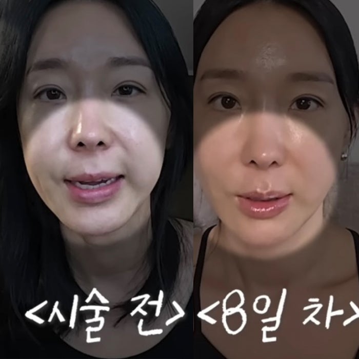 <b>이지혜</b> 팔자주름 실리프팅! 직접 해 본 효과, 가격, <b>부작용</b>... 