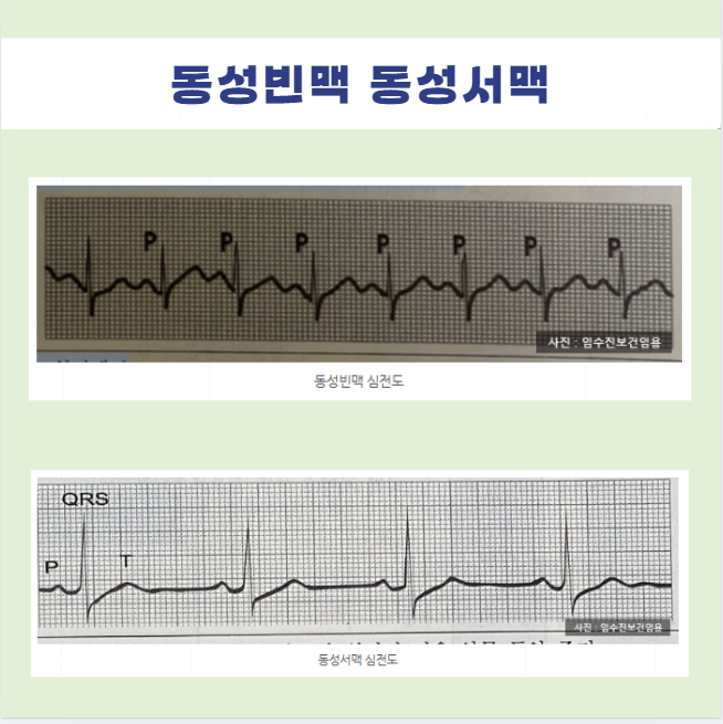 부정맥 동성빈맥 동성서맥 Sinus tachycardia bradycardia 뜻 원인 증상 치료 심전도