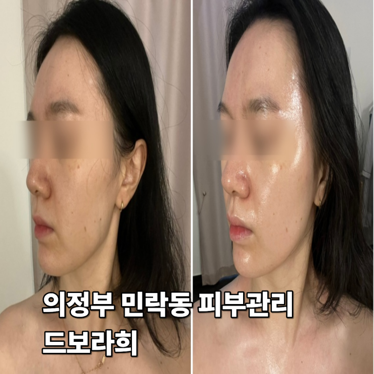  의정부 민락동 피부관리 드보라희 엑소좀 필링 테라피 강력추천