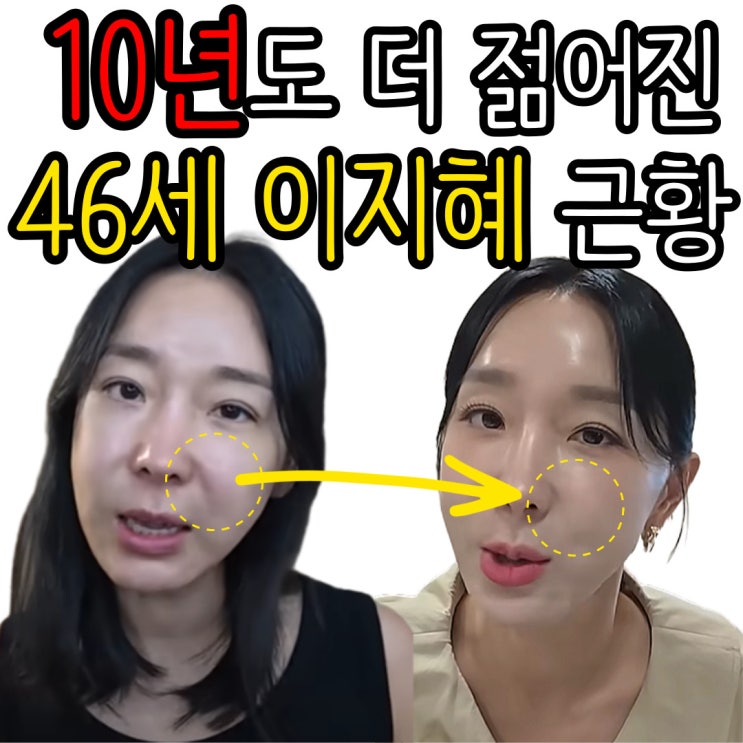 46세 <b>이지혜</b> 실리프팅 후기... 실리프팅 가격 통증 붓기 <b>부작용</b>)