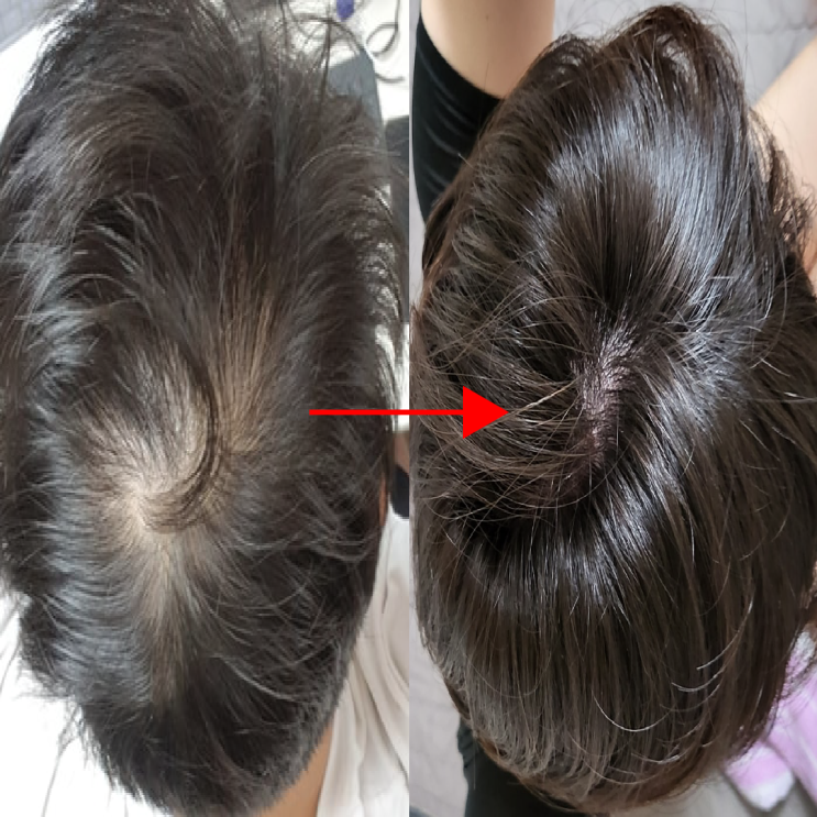  Rogaine 효과와 시너지