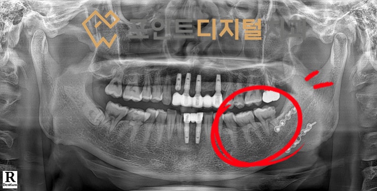  [탕정치과]  타지역에서 발치하고 오신 환자분(디지털 가이드 + 비절개 임플란트 + 하이니스 디지털 보철) / 천안 아산
