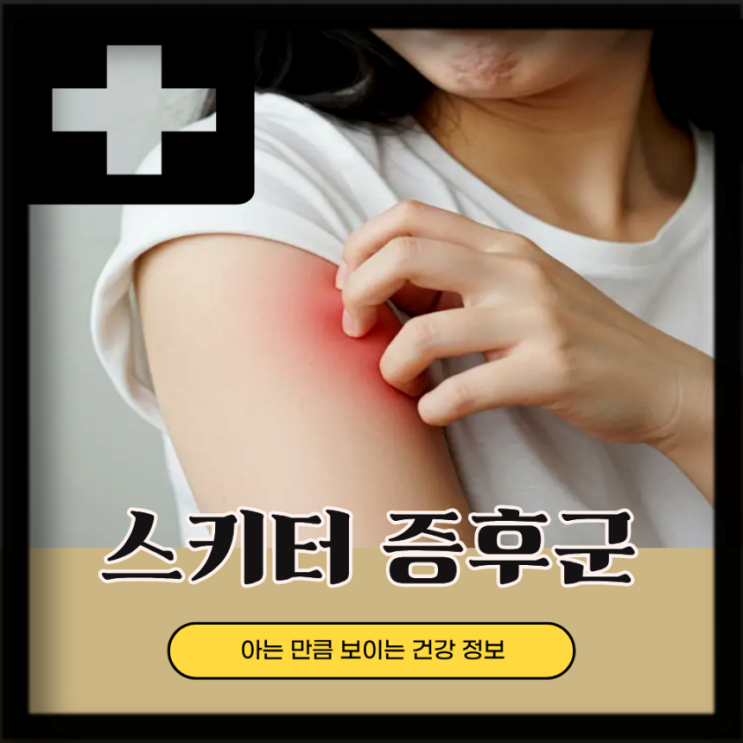  모기물렸을때 퉁퉁? 모기 알레르기 스키터증후군 증상 연고